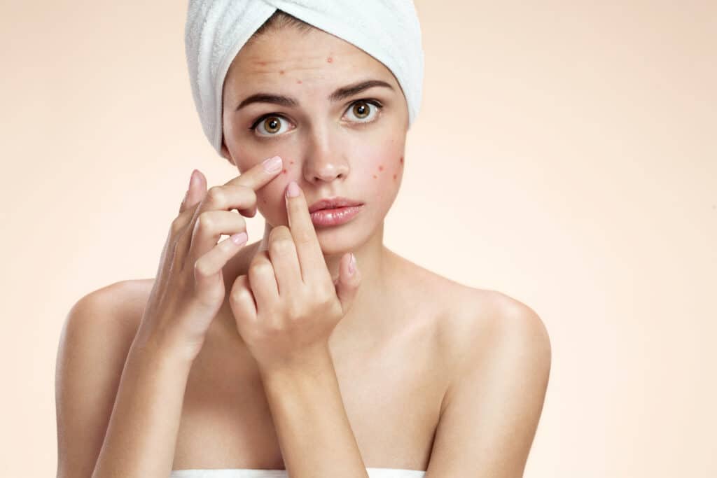 Acne Treatment Allentown PA