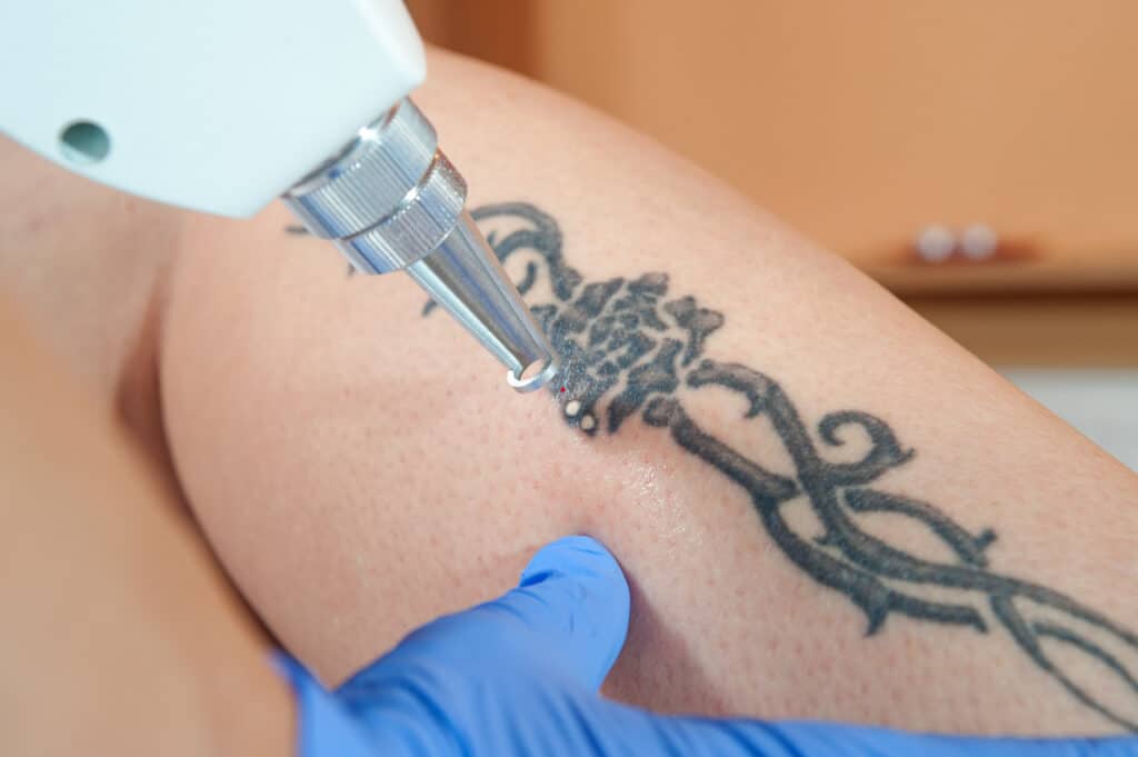 laser tattoo removal from leg
