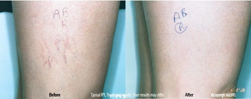 Before and After Image: IPL - front