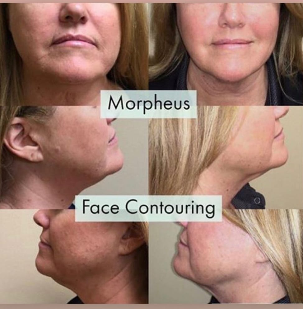 Before and After Image: Morpheus8 + Face Contouring - front