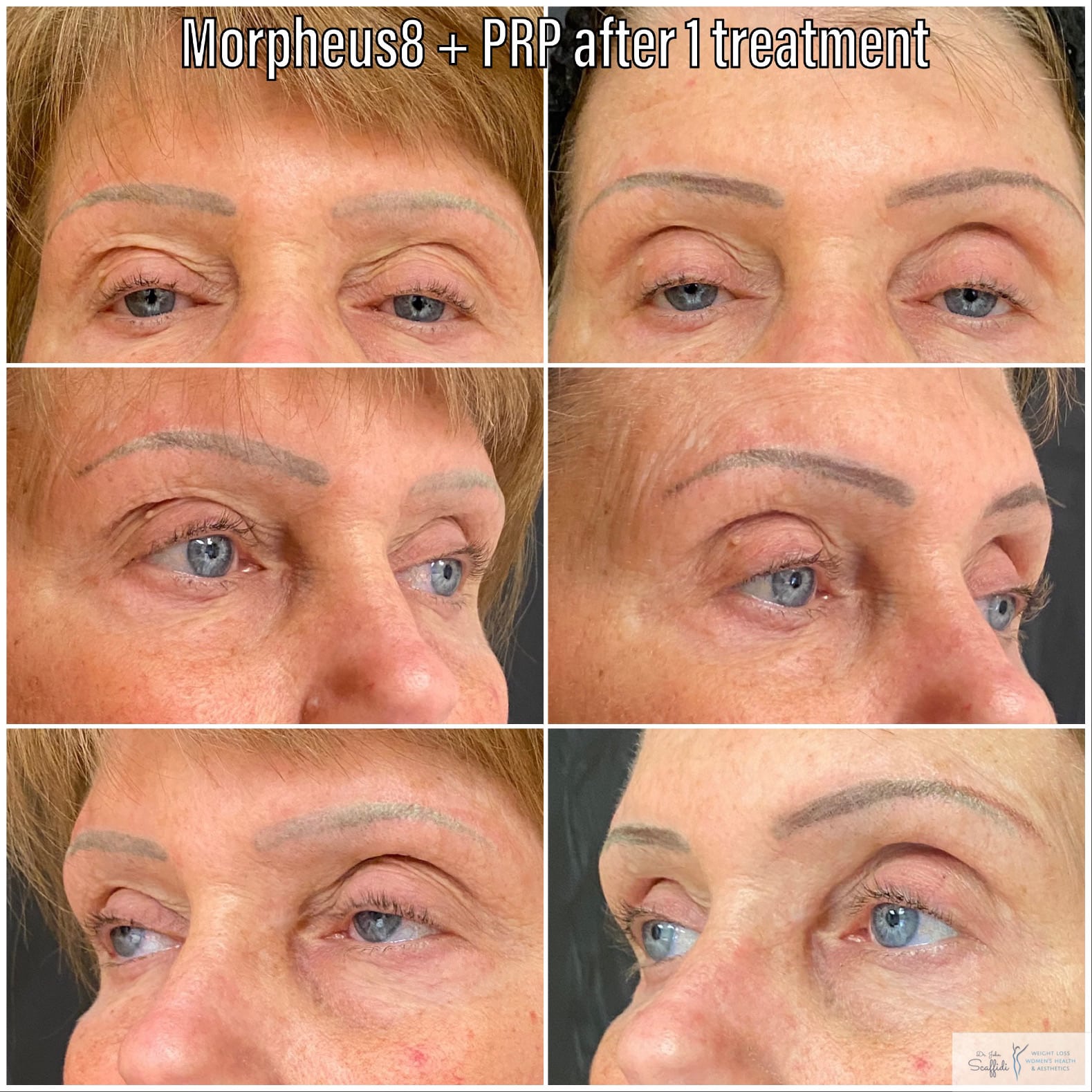 Before and After Image: Morpheus8 + PRP - front