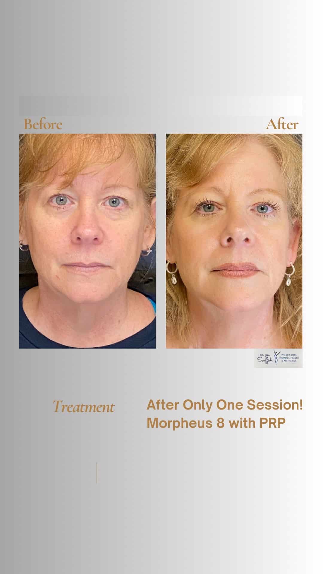 Before and After Image: Venus Bliss Max - front