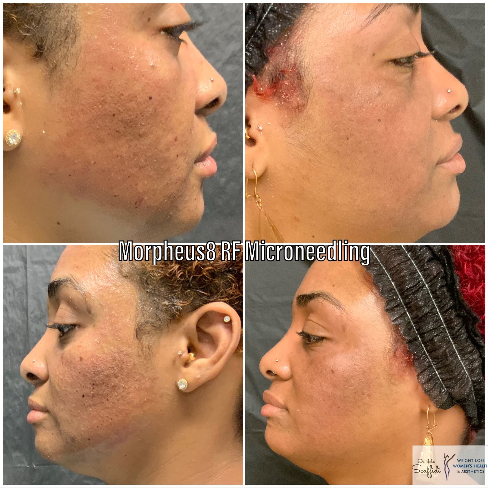 Before and After Image: Morpheus8 - front