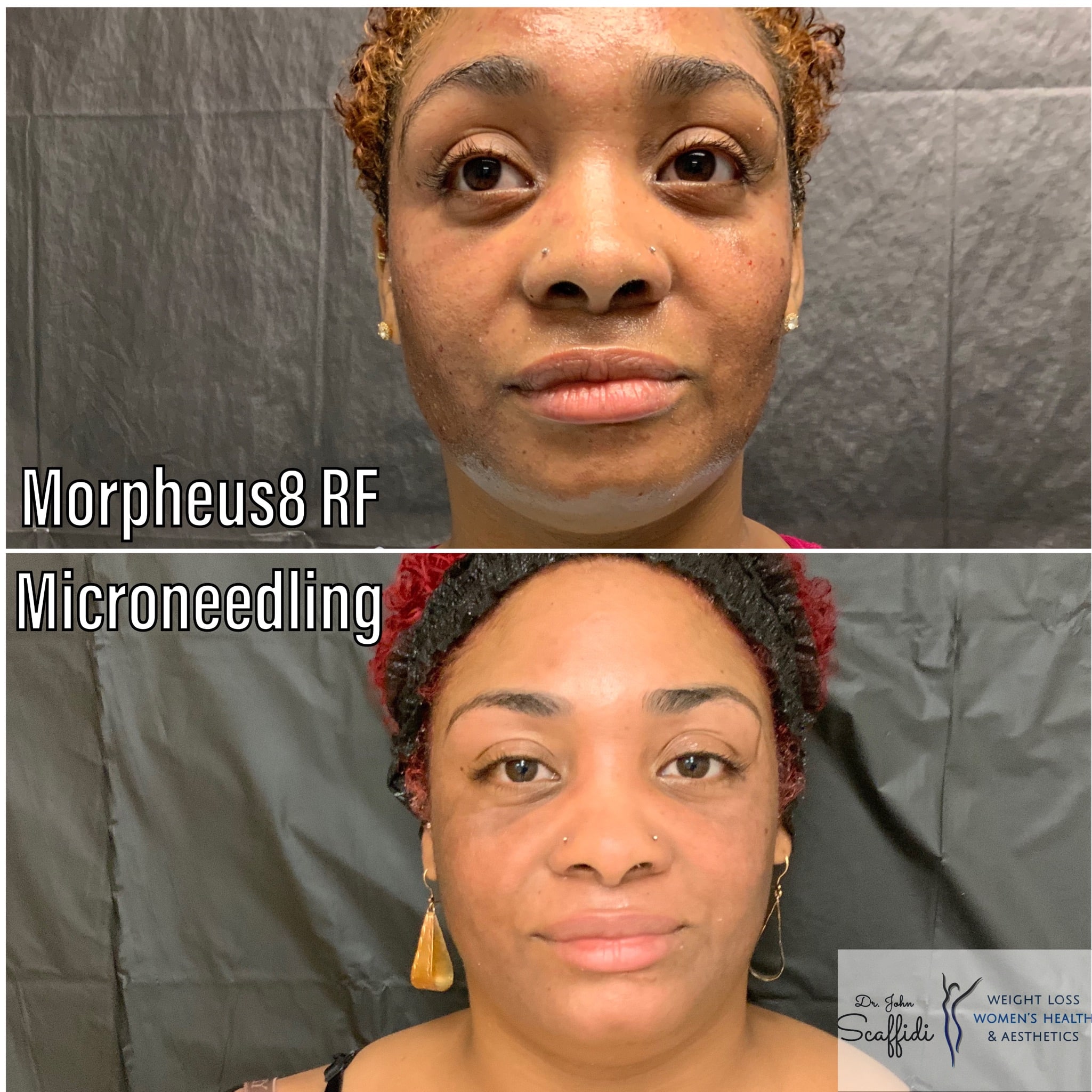 Before and After Image: Morpheus8 - front