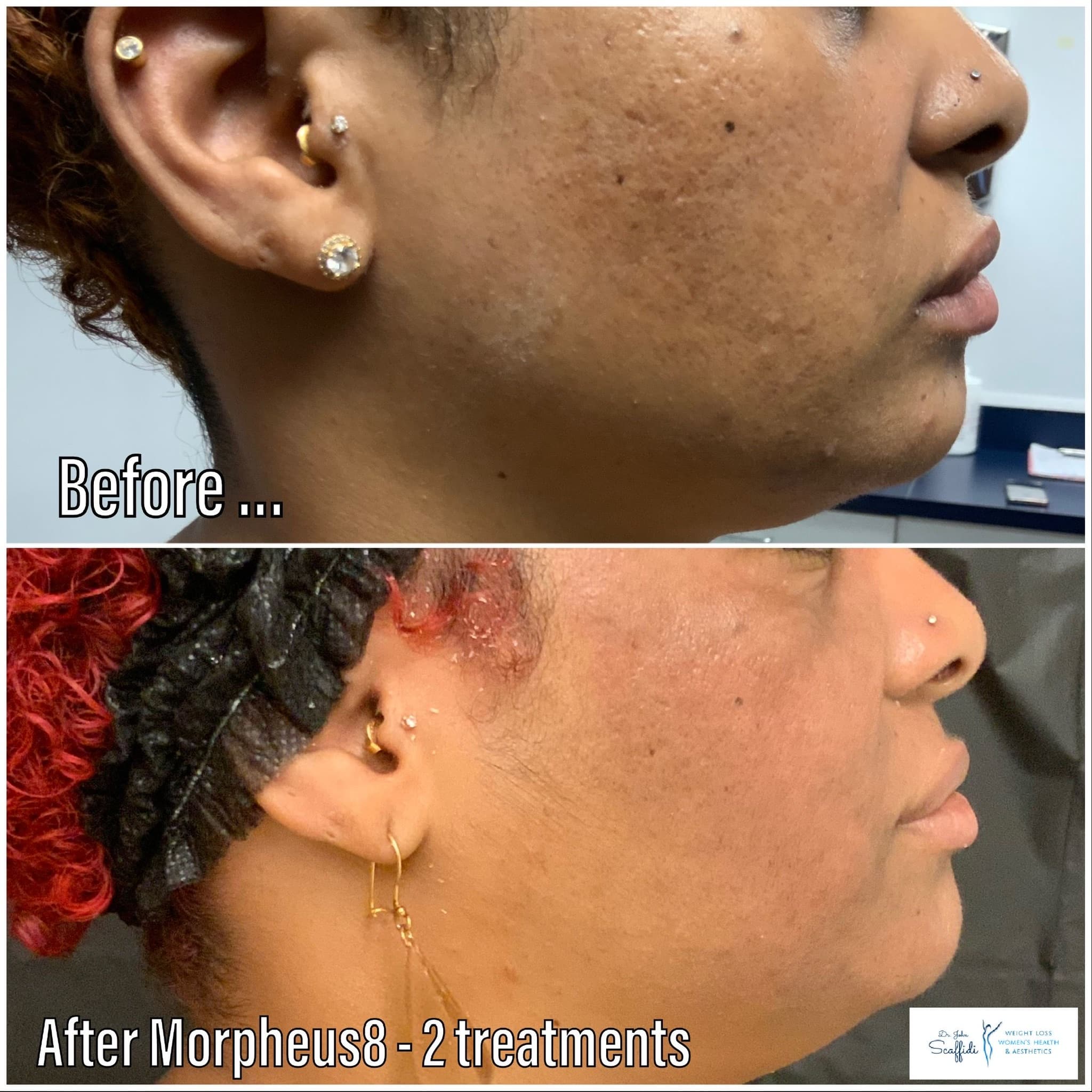 Before and After Image: Morpheus8 - right-side