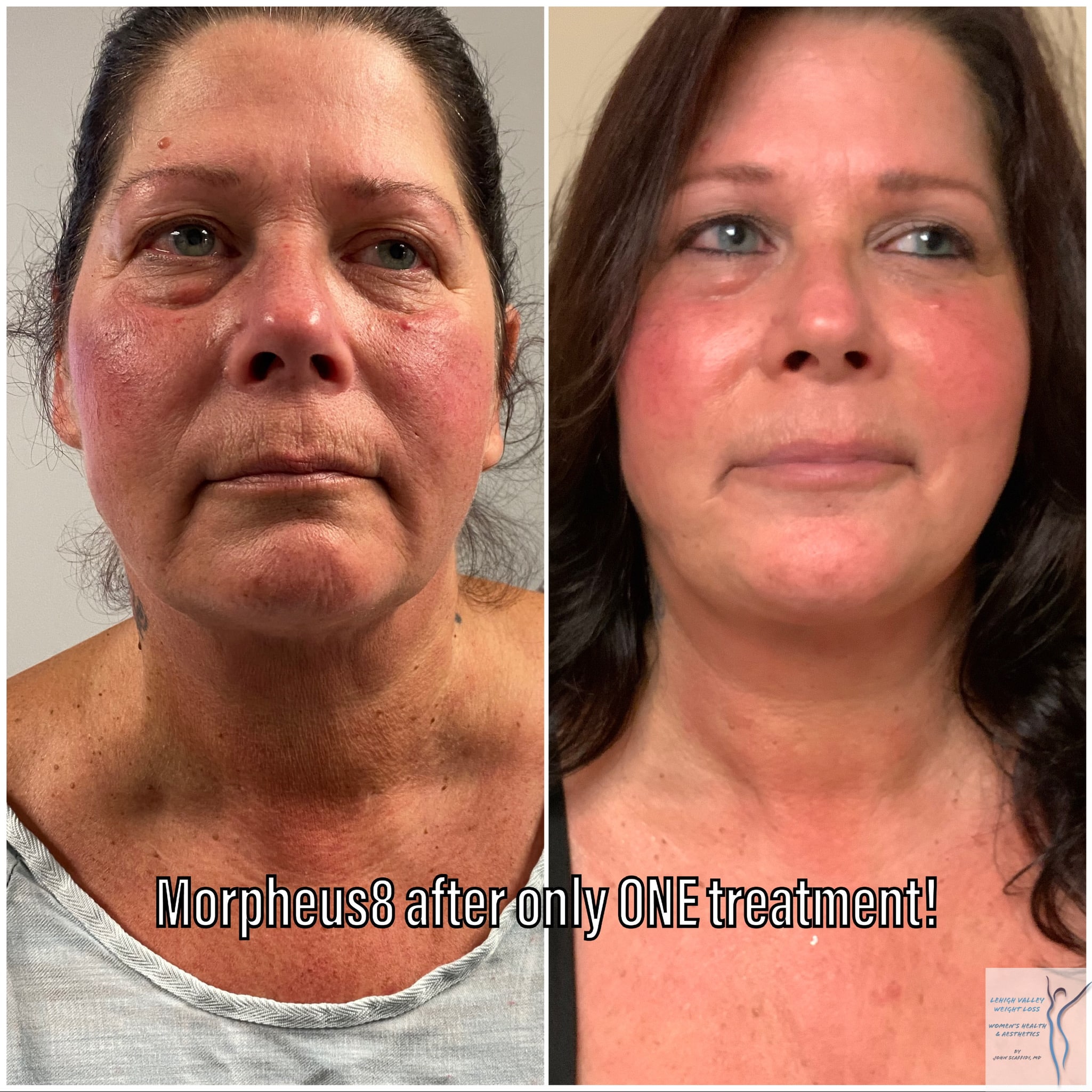 Before and After Image: Morpheus8 - front