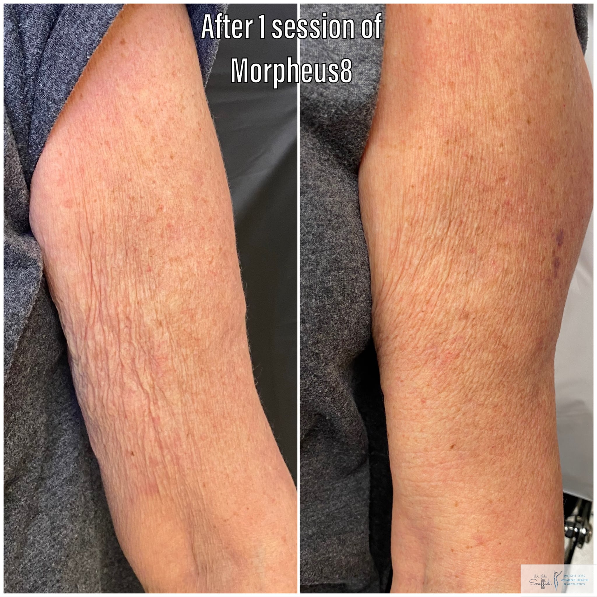 Before and After Image: Morpheus8 - front