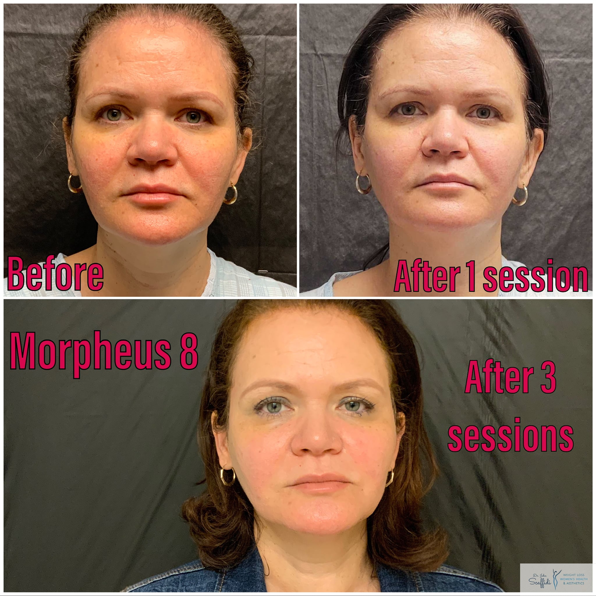 Before and After Image: Morpheus8 - front