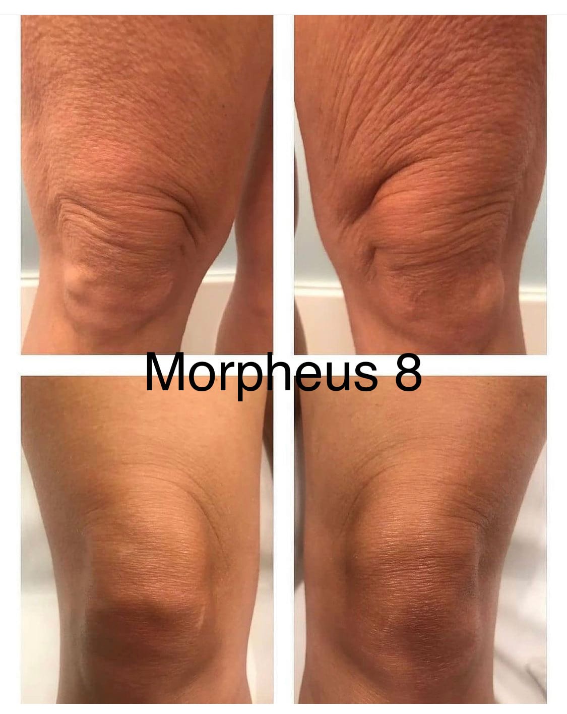 Before and After Image: Morpheus8 - front