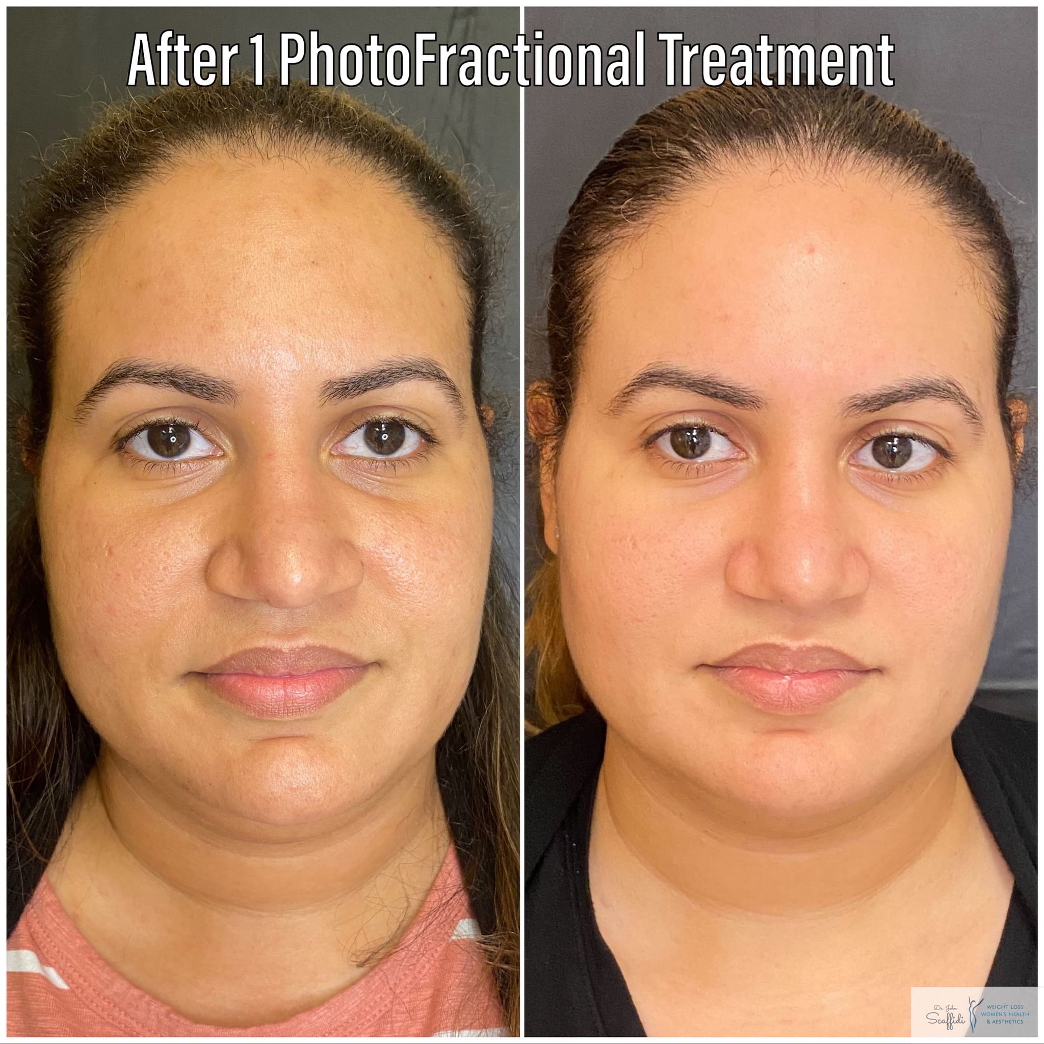 Before and After Image: PhotoFractional - front