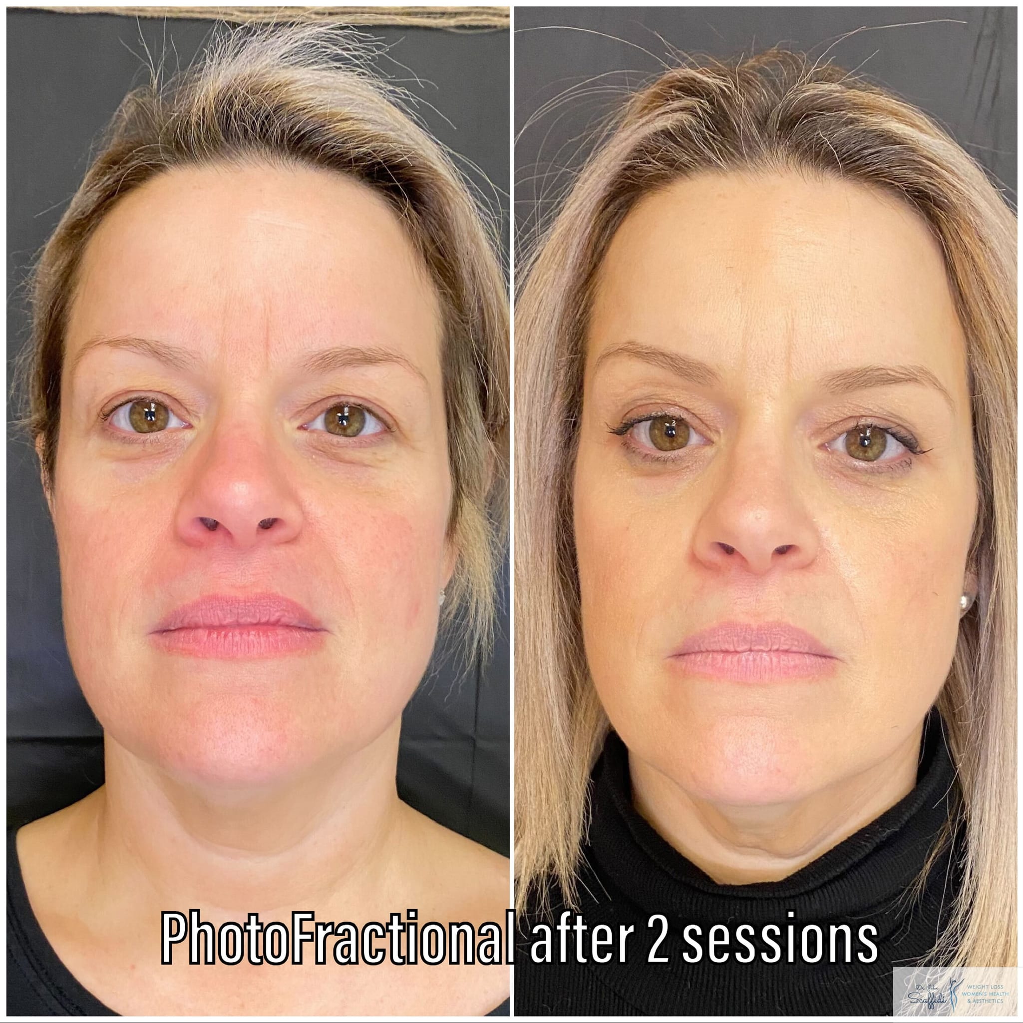 Before and After Image: PhotoFractional - front