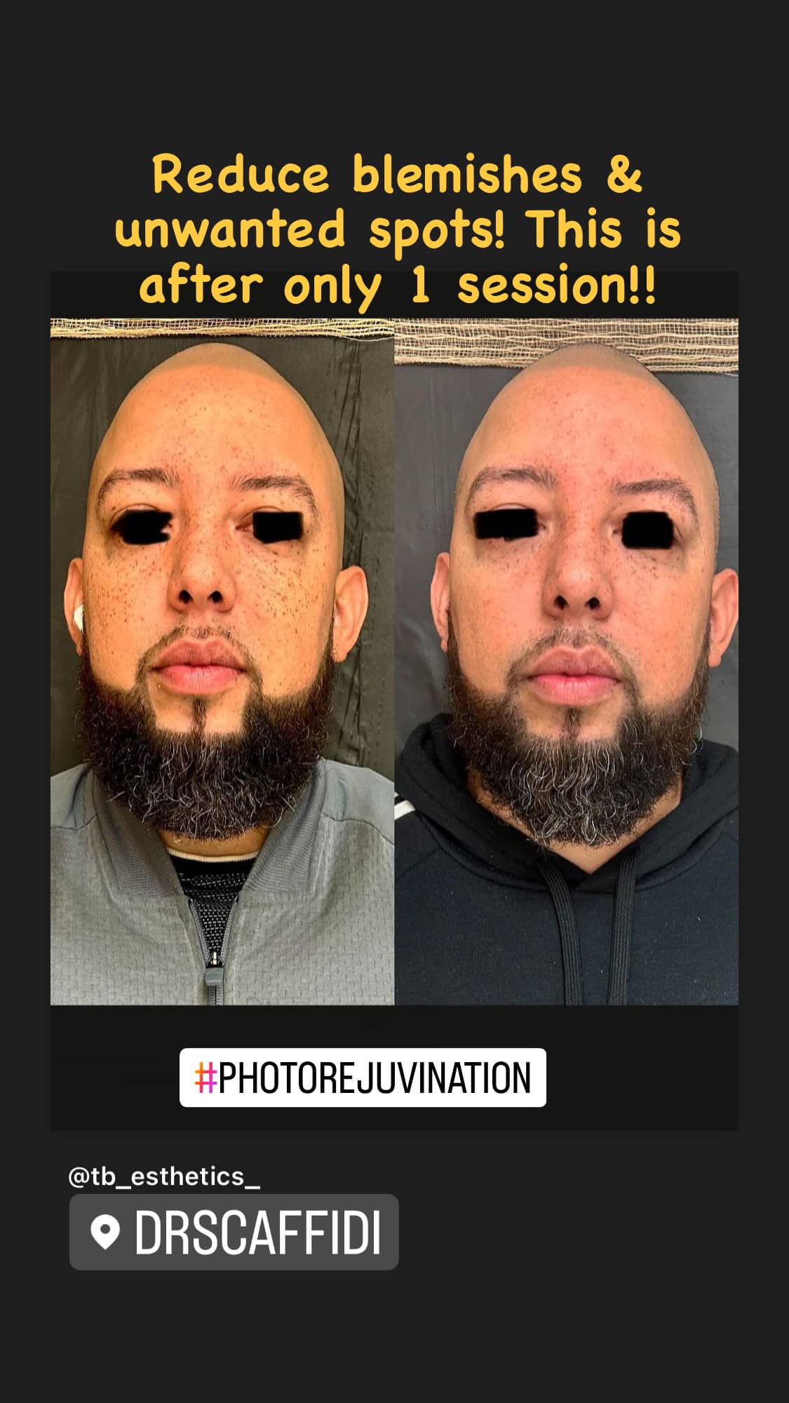 Before and After Image: Photorejuvenation - front