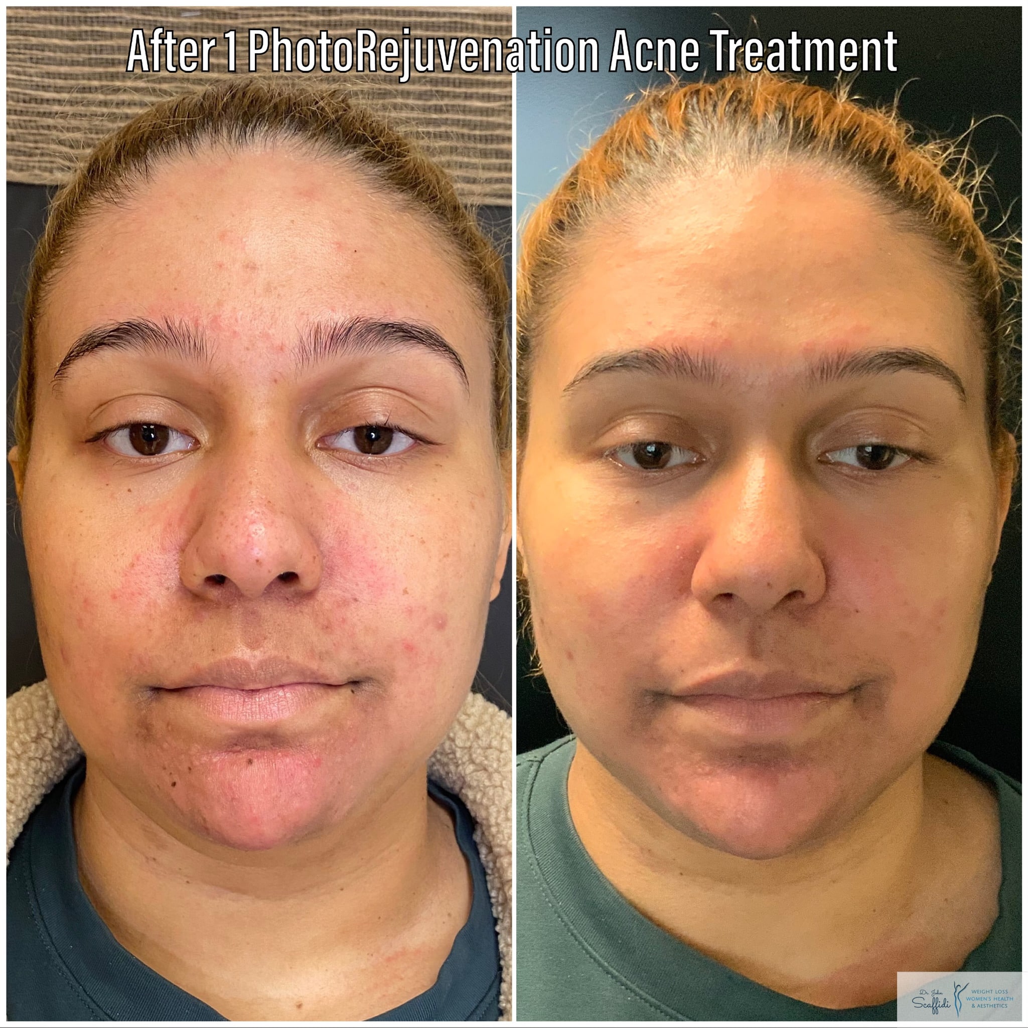 Before and After Image: Photorejuvenation - front
