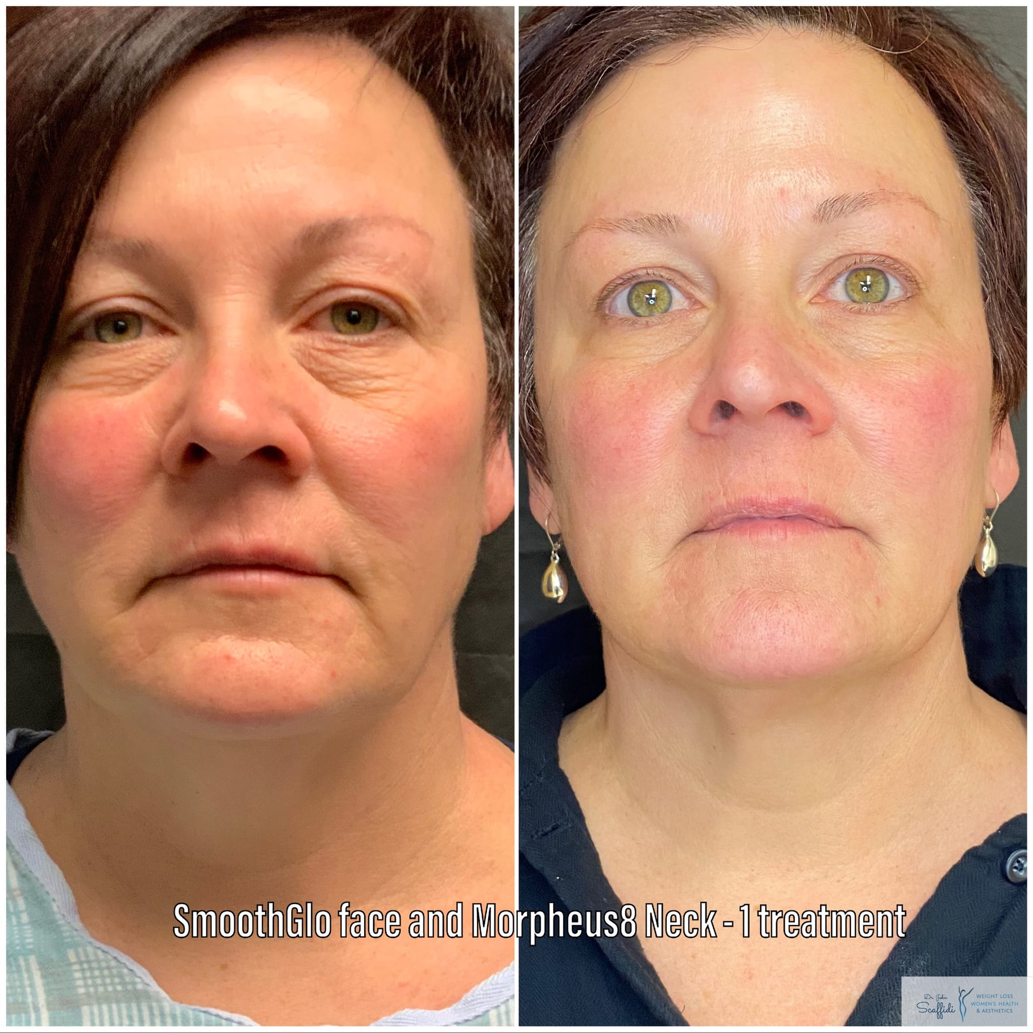 Before and After Image: SmoothGlo and Morpheus8 - front