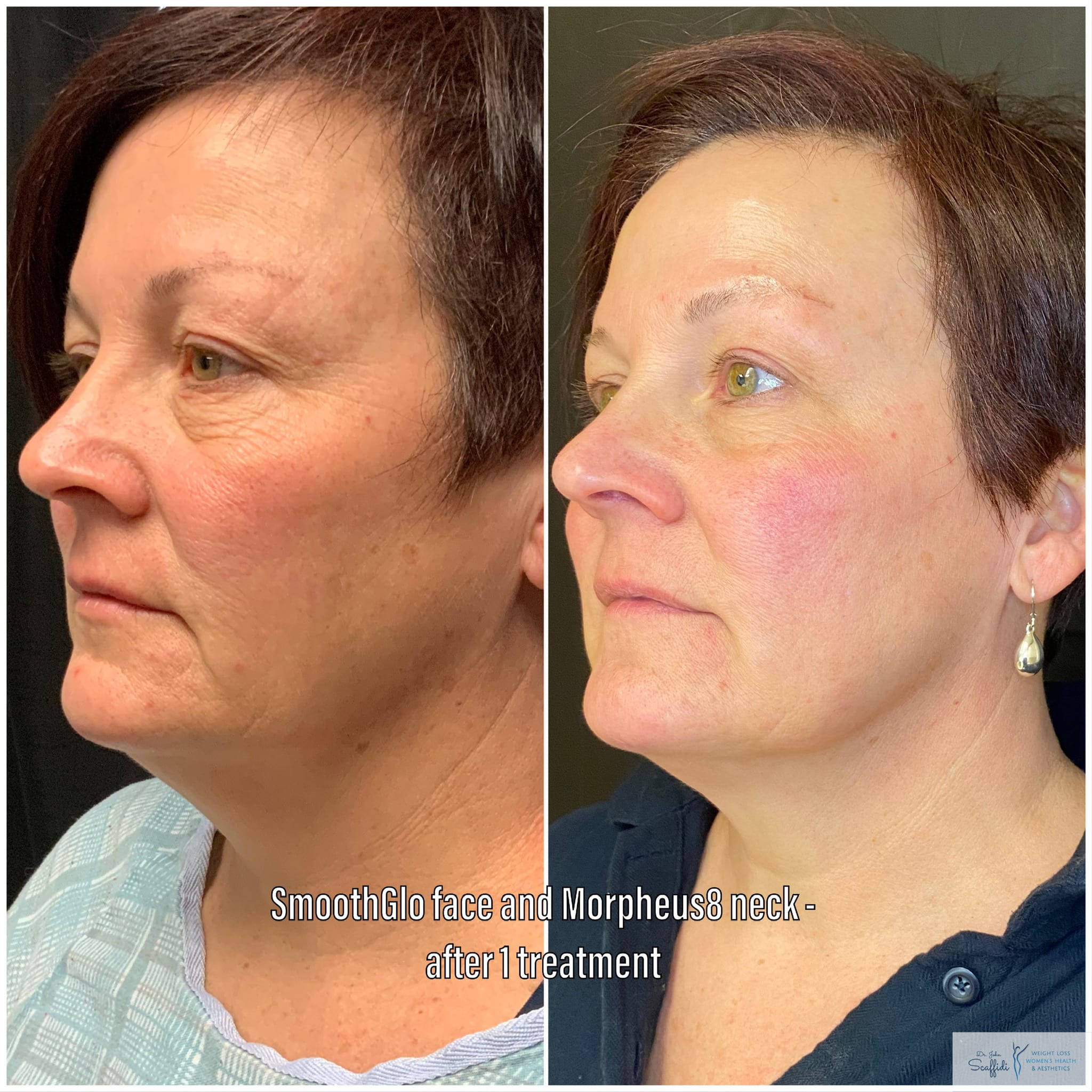 Before and After Image: SmoothGlo and Morpheus8 - left-front-oblique