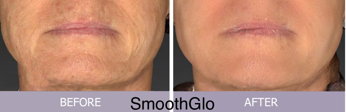 Before and After Image: SmoothGlo - front