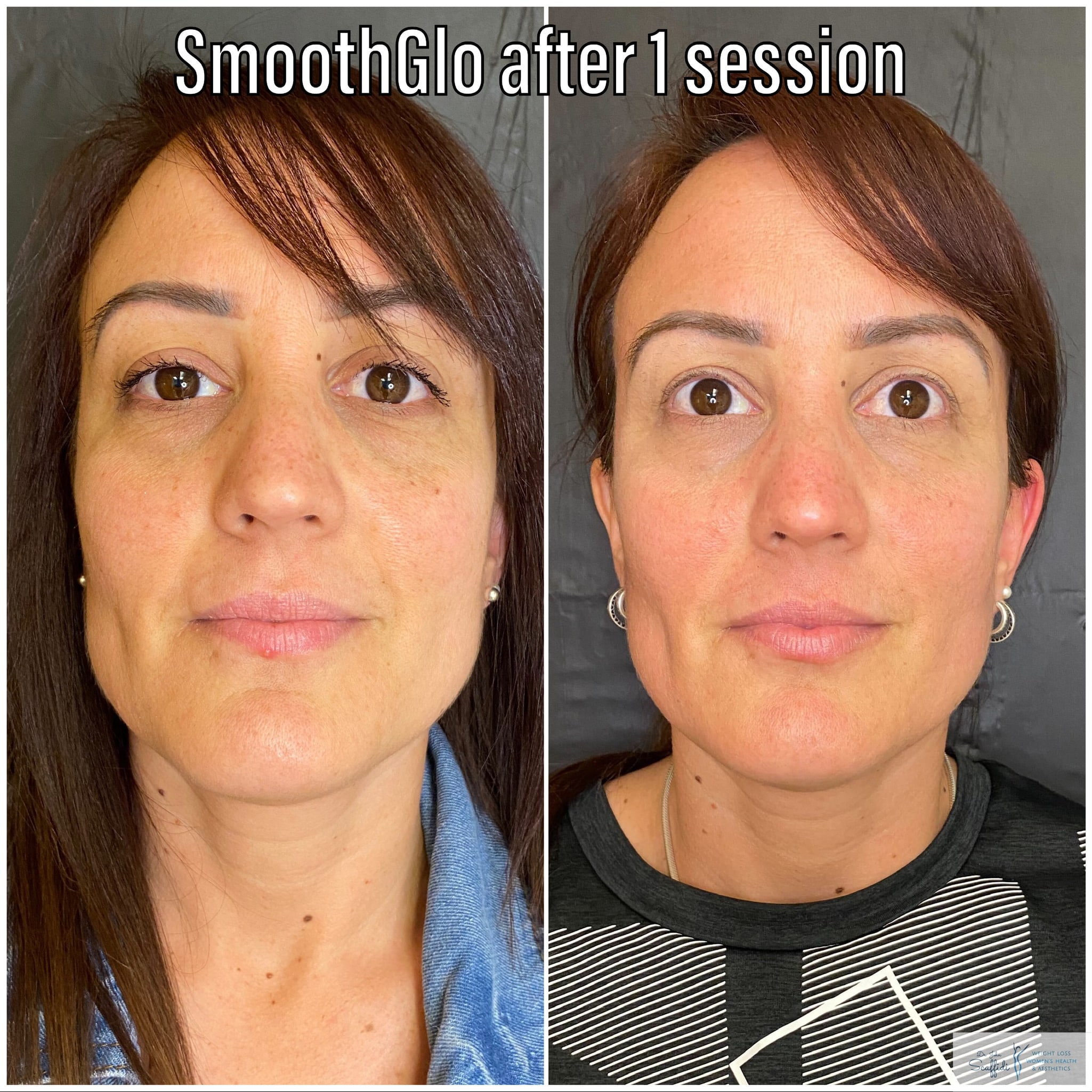 Before and After Image: SmoothGlo - front