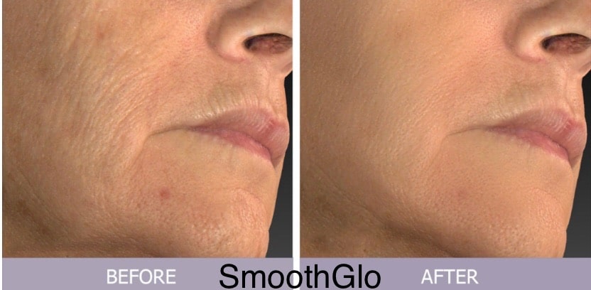 Before and After Image: SmoothGlo - right-front-oblique