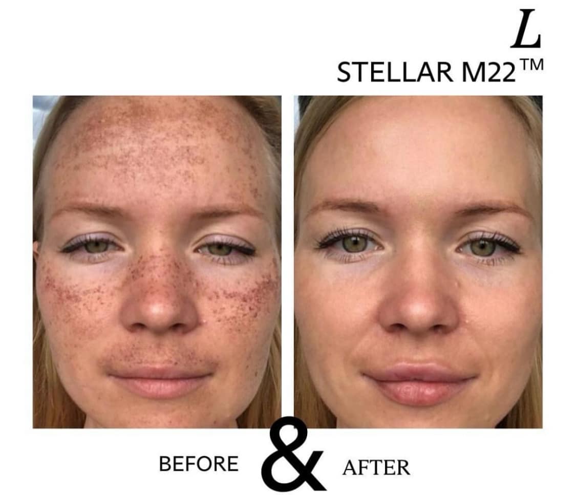 Before and After Image: Stellar M22 - front