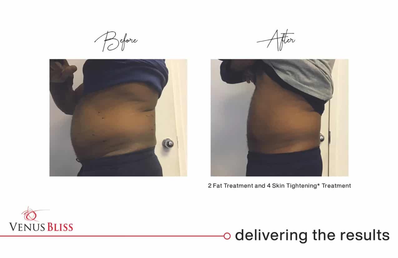 Before and After Image: Venus Bliss Max - left-side