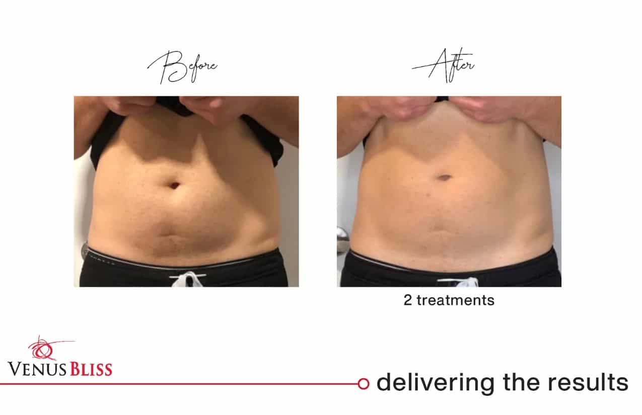 Before and After Image: Venus Bliss Max - front