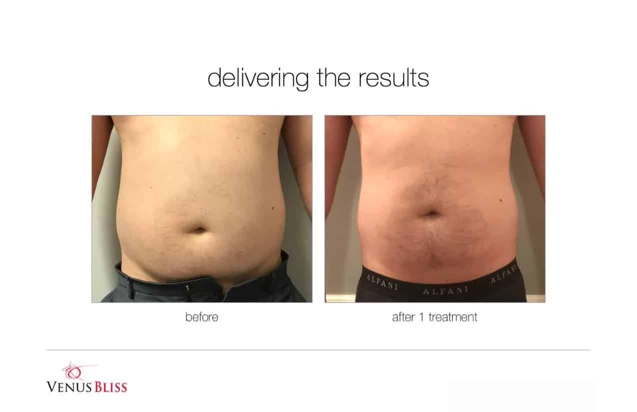 Before and After Image: Venus Bliss Max - front