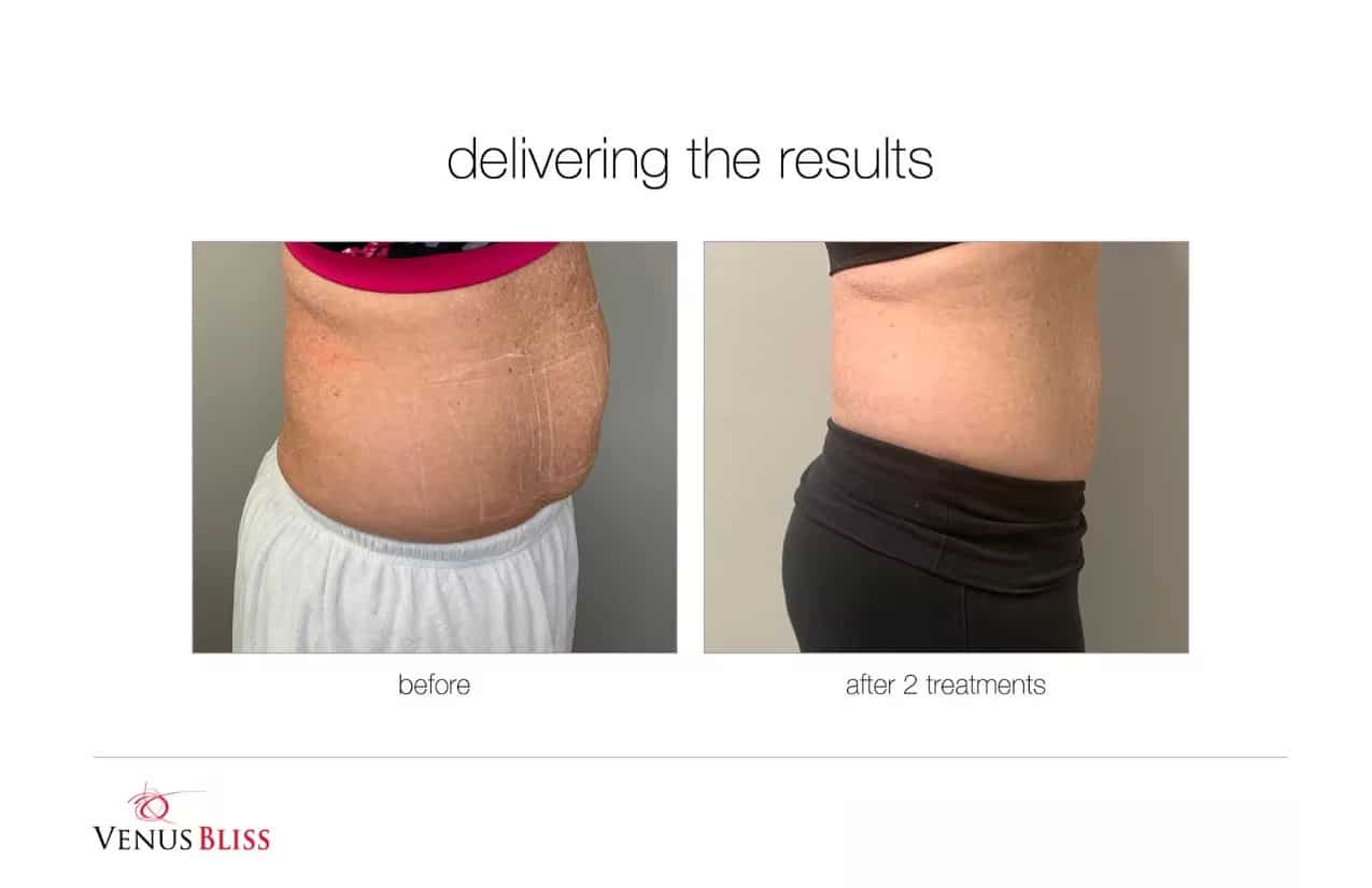 Before and After Image: Venus Bliss Max - right-side