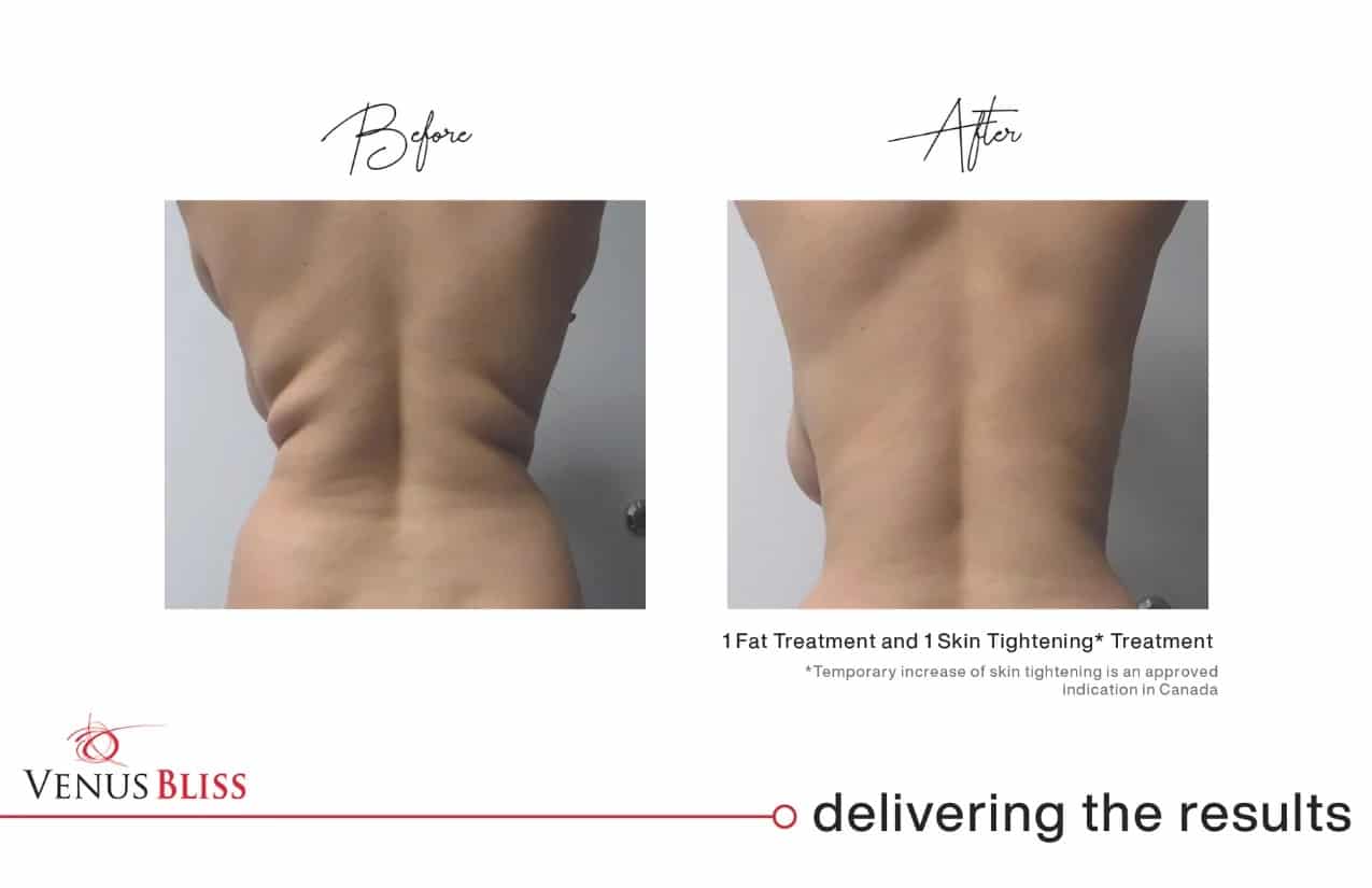 Before and After Image: Venus Bliss Max - back