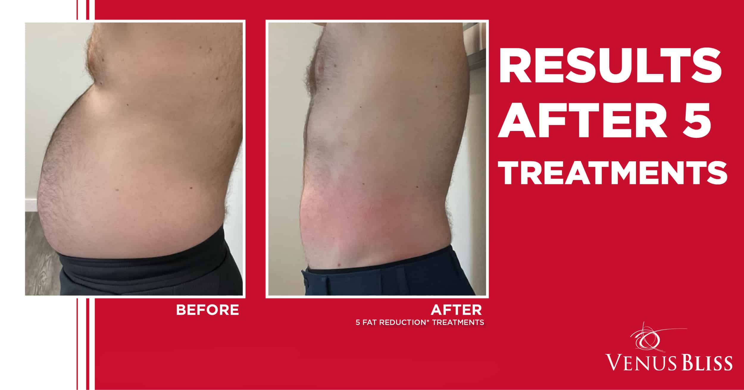 Before and After Image: Venus Bliss Max - left-side