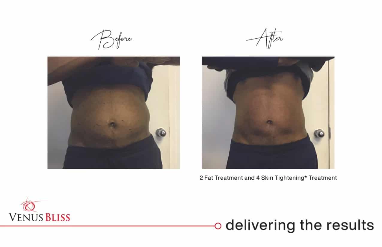 Before and After Image: Venus Bliss Max - front