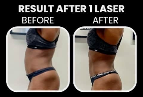 Before and After Image: Venus Bliss Max - left-side