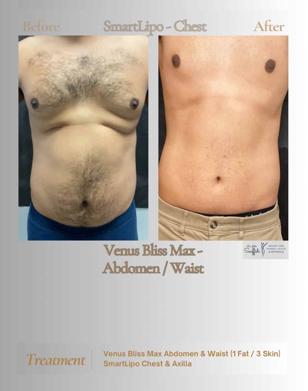 Before and After Image: Venus Bliss - front