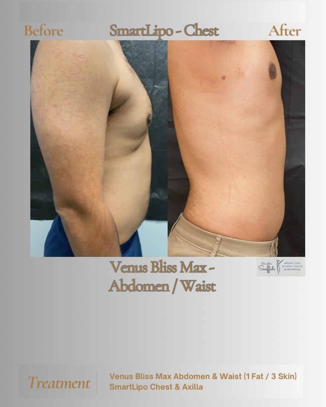 Before and After Image: Venus Bliss - right-side