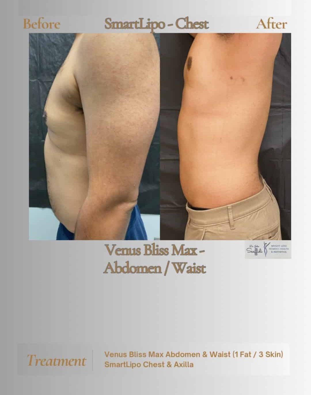 Before and After Image: Venus Bliss - left-side