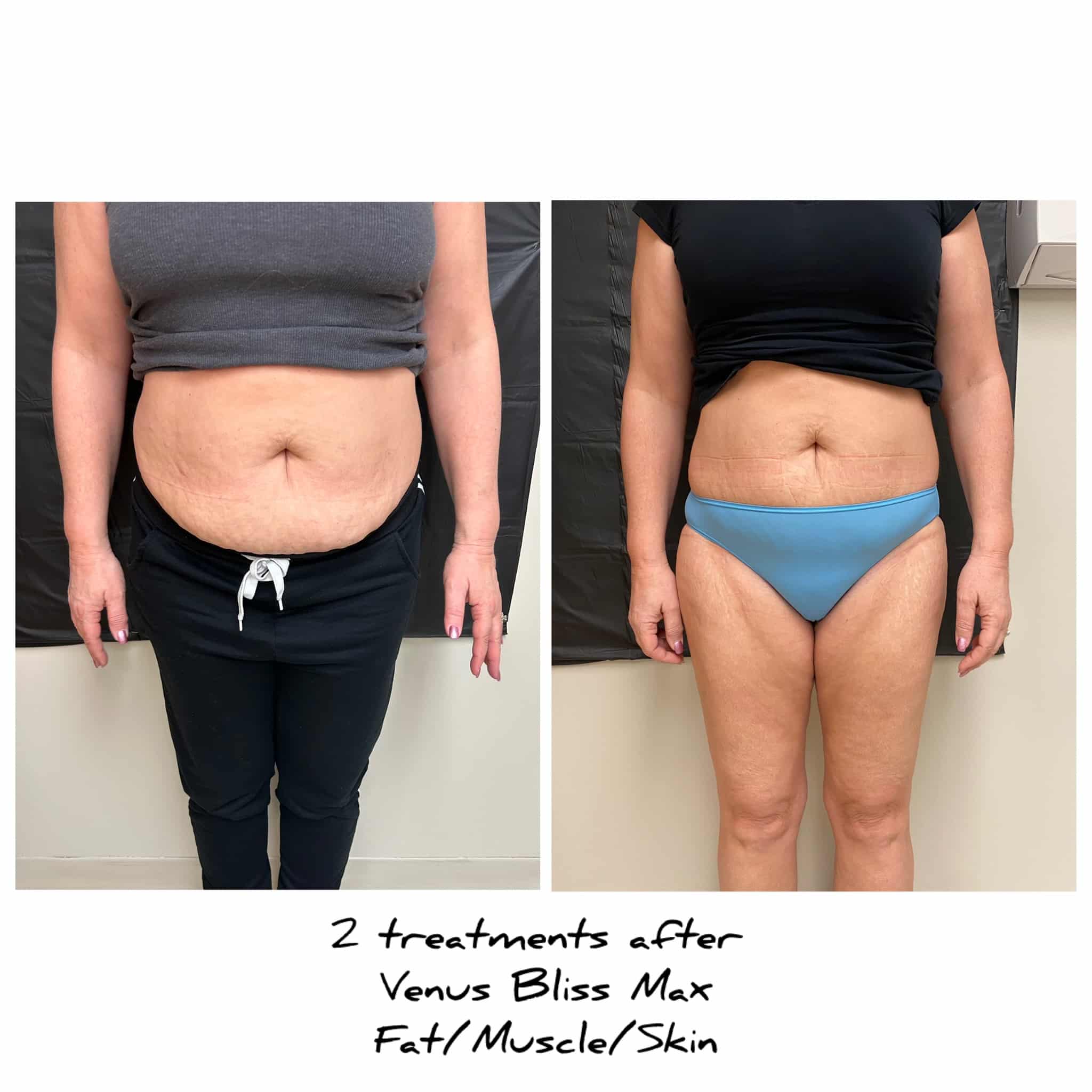 Before and After Image: Venus Bliss Max - front