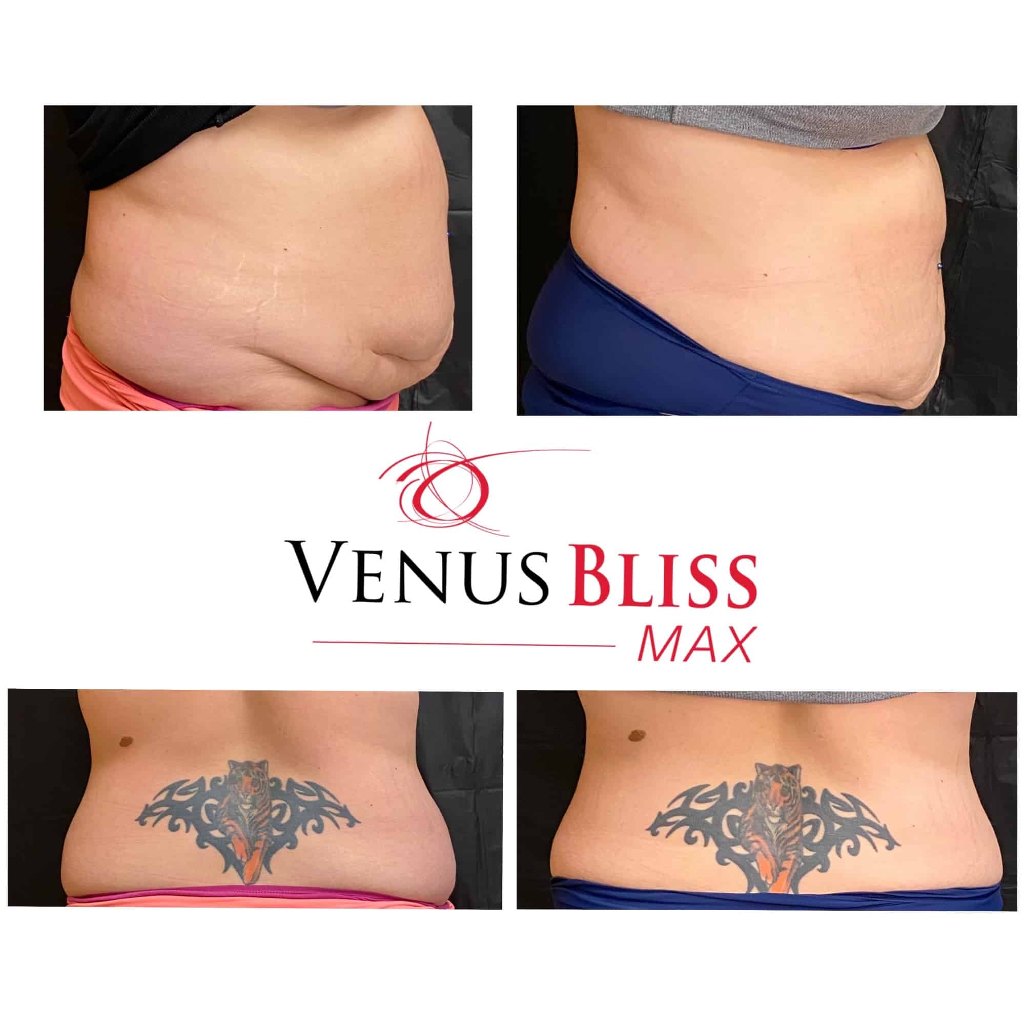Before and After Image: Venus Bliss Max - right-side