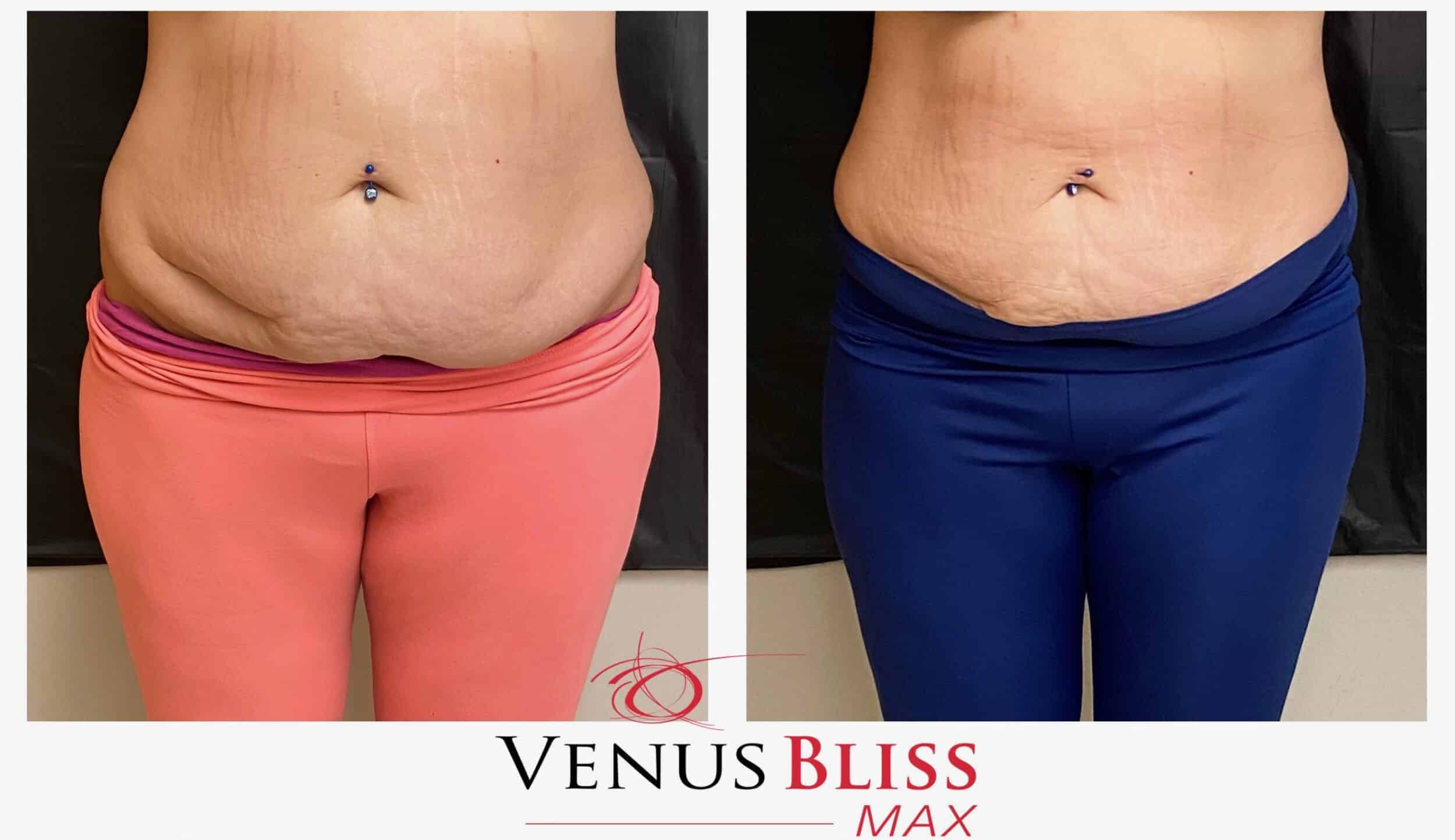 Before and After Image: Venus Bliss Max - front