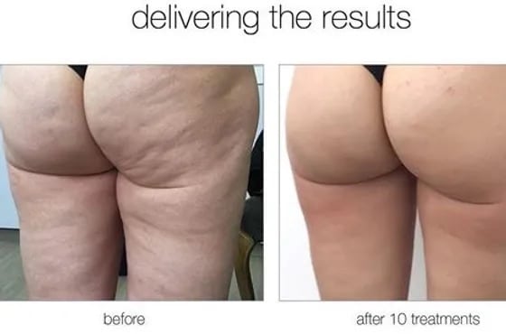 Before and After Image: Venus Cellulite - right-back-oblique