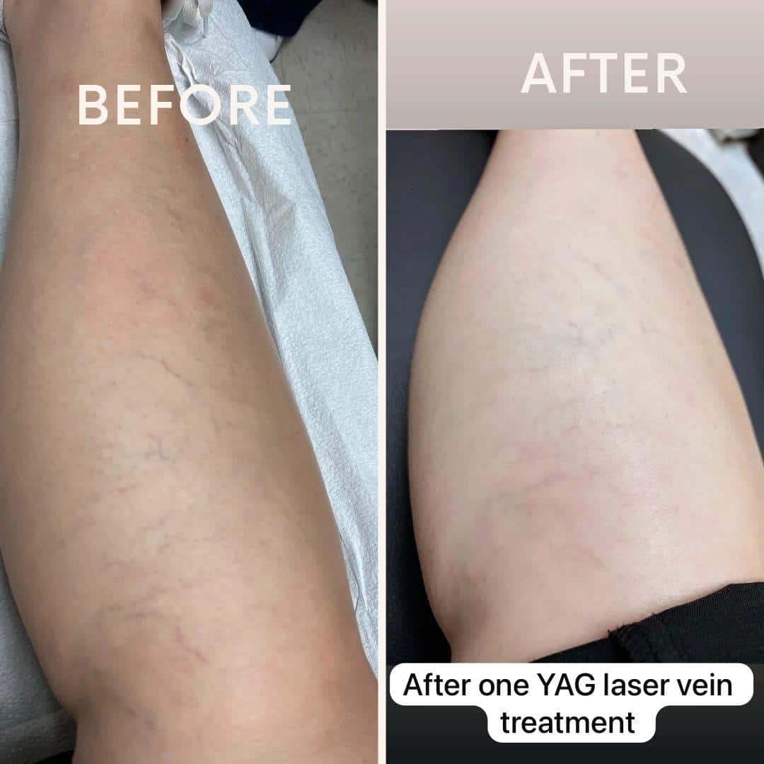 Before and After Image: YAG Laser Vein - front