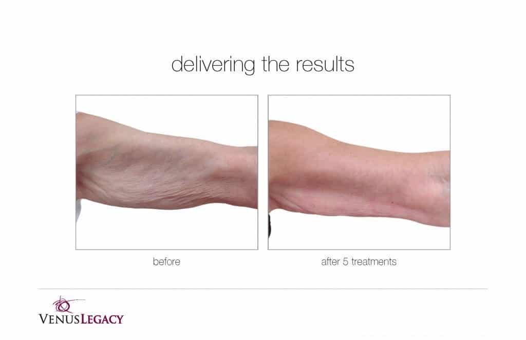 Before and After Image: Venus Bliss Max - front