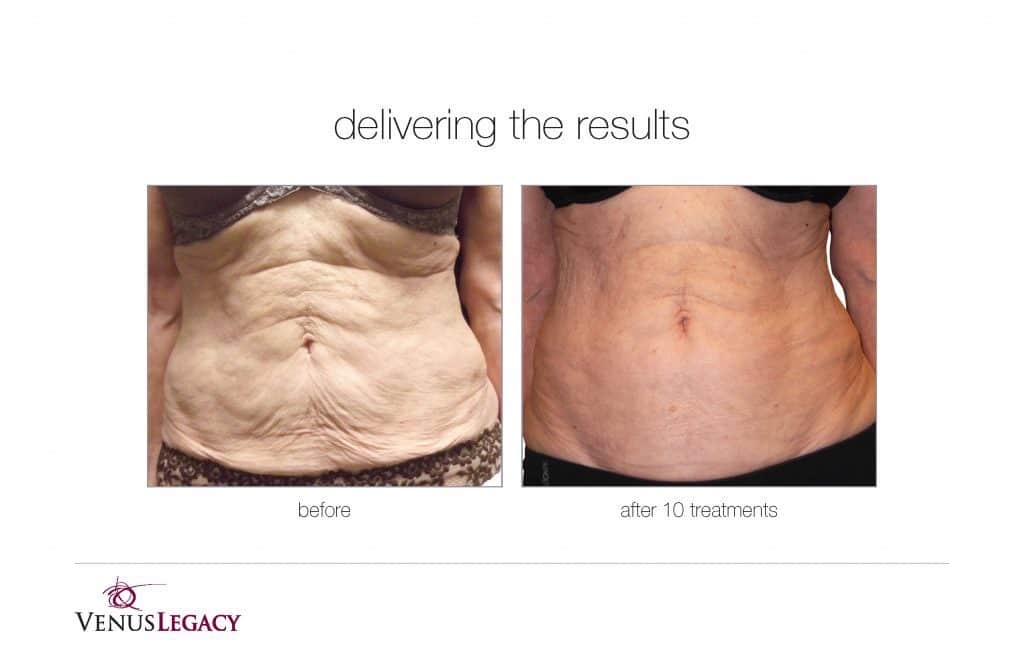 Before and After Image: Venus Bliss Max - front