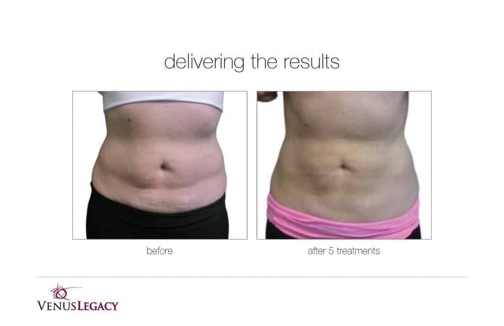 Before and After Image: Venus Bliss Max - front