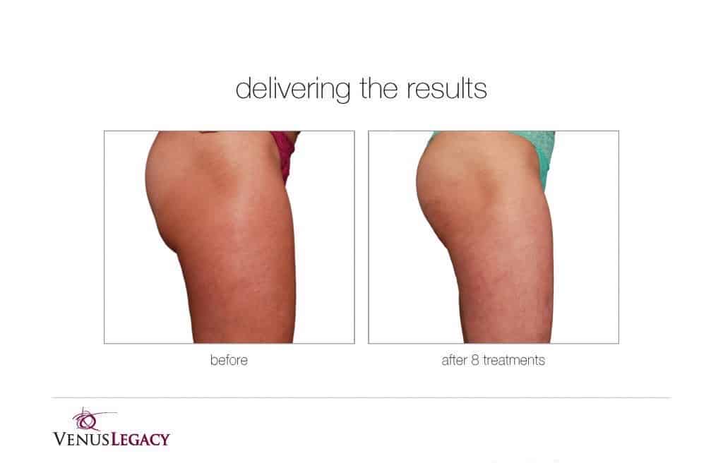 Before and After Image: Venus Bliss Max - right-side