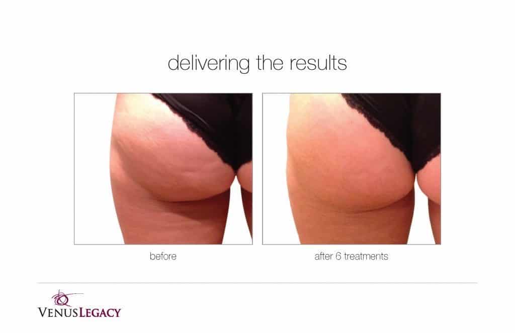 Before and After Image: Venus Bliss Max - back