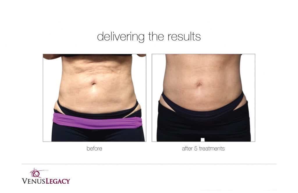 Before and After Image: Venus Bliss Max - front