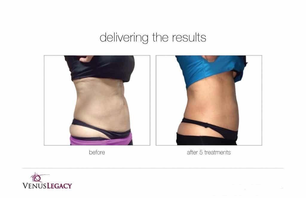 Before and After Image: Venus Bliss Max - right-side