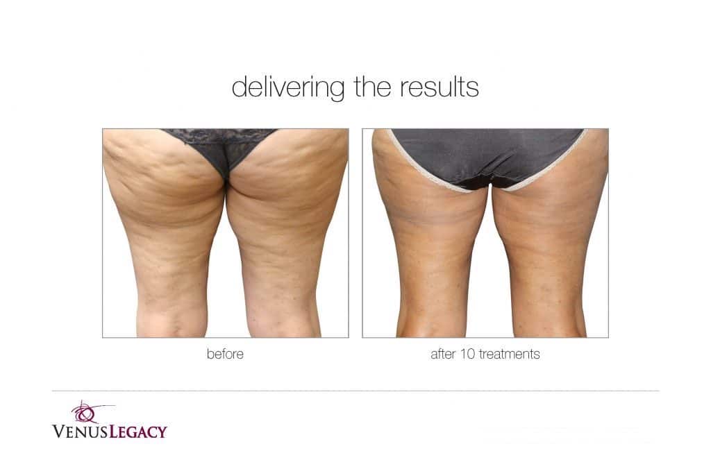 Before and After Image: Venus Bliss Max - back