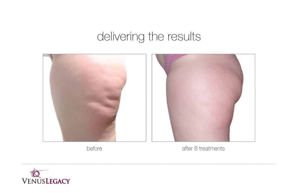 Before and After Image: Venus Bliss Max - left-side