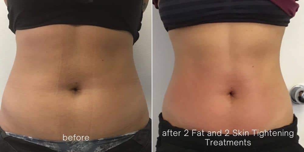 Before and After Image: Venus Bliss Max - front