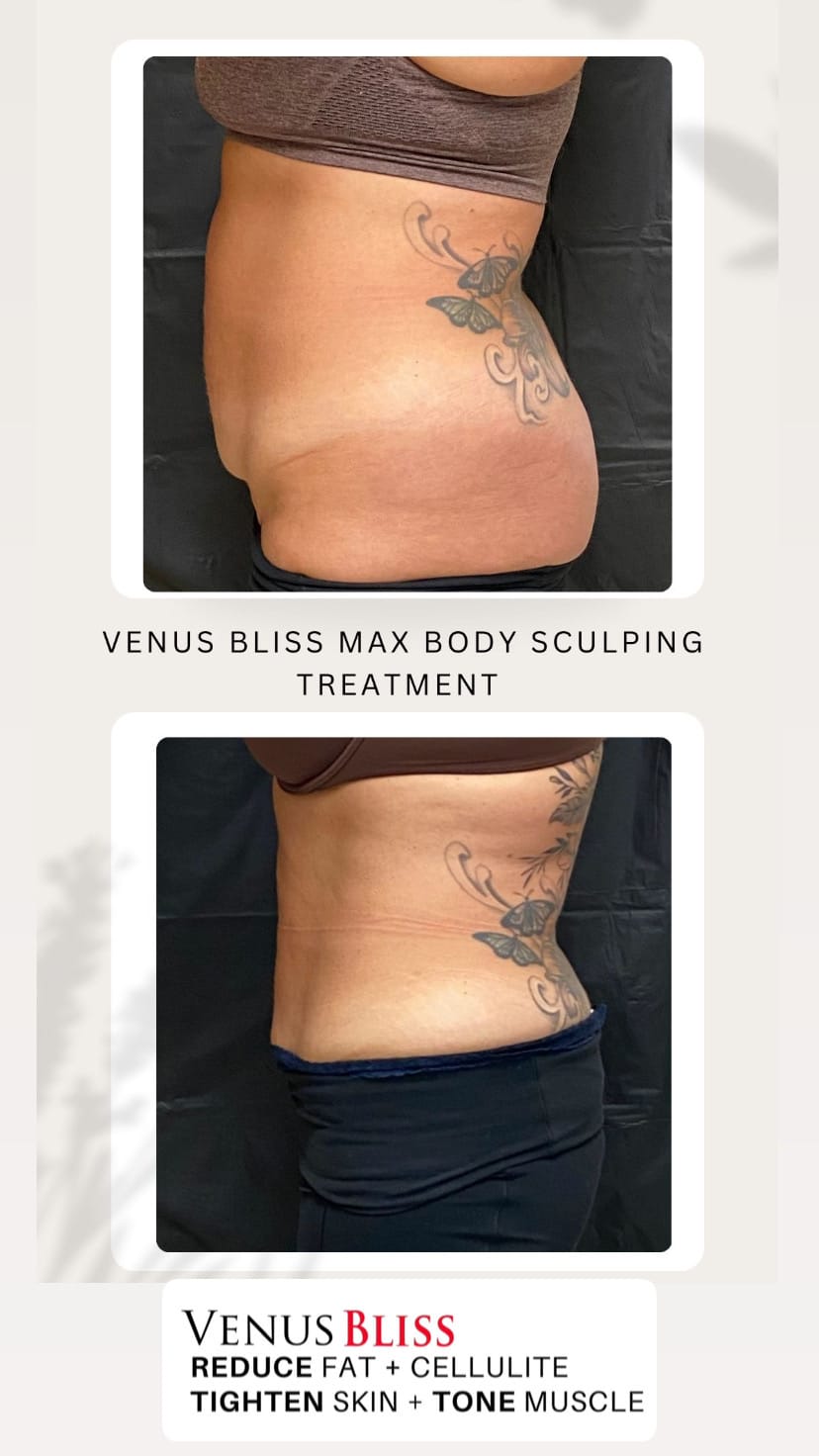 Before and After Image: Venus Bliss Max - left-side